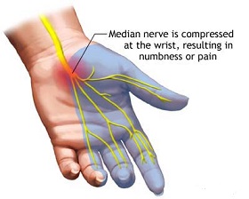 Avoiding Neck and Shoulder Pain and Carpal Tunnel When Using a Treadmill Desk Anatomy of the hand, median nerve, carpal tunnel