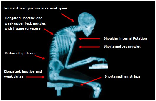 The human skeleton bent over a computer keyboard, showing computer hunch posture.